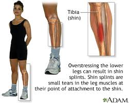 This video will help you with 1. Leg Pain Information Mount Sinai New York