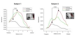 Meaning of ipsilateral in english. Response Of Sii Cortex To Ipsilateral Contralateral And Bilateral Flutter Stimulation In The Cat Bmc Neuroscience Full Text
