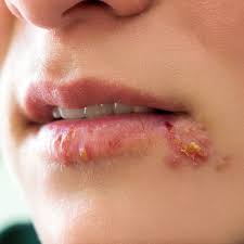 Avec un herpès autour de la bouche en pleine crise, on a envie de se gratter. L Herpes Du Visage Doctissimo