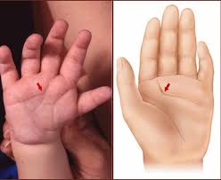 Maybe you would like to learn more about one of these? Hockey Stick Palmar Crease A Characteristic In Charge Fetal Alcohol Syndrome Hand Facts News About Hands