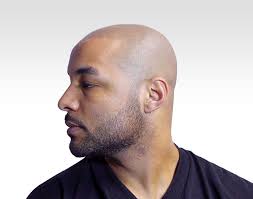 Questo tipo di trattamento consente di portare i capelli a lunghezze. Micropigmentazione Dello Scalpo