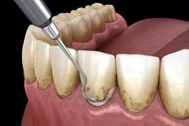 Jun 20, 2021 · dental deep cleaning cost. Scaling And Root Planing Washington Dc City Smiles Dc Scaling And Root Planing Deep Cleaning Dentist Washington Dc
