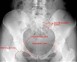 The main purposes of the pelvic girdle are to support and protect the abdominal and pelvic organs, and to connect the trunk and lower limbs. Pelvis Anatomy Recon Orthobullets