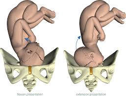 Image result for Brow Presentation