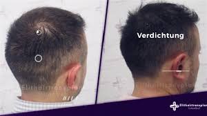 668 просмотров 7 месяцев назад. Haarpigmentierung Deutschland Vorher Nachher Bilder Youtube