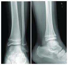 Image result for Ankle XRay
