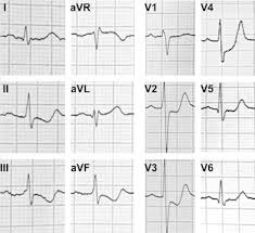 Diagnostic criteria for dewinter t waves. The De Winter Ecg Pattern In The Absence Of Acute Coronary Artery Occlusion Sciencedirect