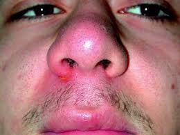 Nasal vestibulitis, or nasal folliculitis, is a rare type of bacterial infection at the opening of the nose. Nasal Vestibulitis And Nasal Furunculosis And Mucormycosis Springerlink
