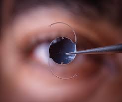 Image result for Cataract Extraction