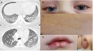 Image result for Multisystem Inflammatory Syndrome