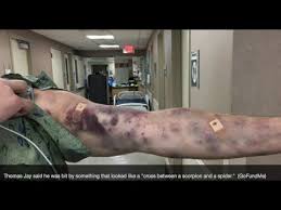 Prophecy Alert Scorpion Locust Revelation Plague Bites Man In Arizona Bruises Bug Bites Medical