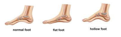 How to tell if you are flat footed. How To Tell If You Have Flat Feet Vionic