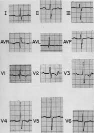 Image result for Endocardial Cushion Defect