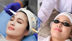 Klinik Kecantikan B Clinic Merilis Perawatan Kulit Teranyar, Kurangi  Produksi Sebum di Wajah