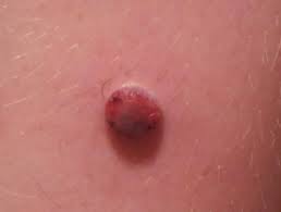 People should check for symptoms of melanoma and other skin cancers every month. Childhood Melanoma Dermnet Nz