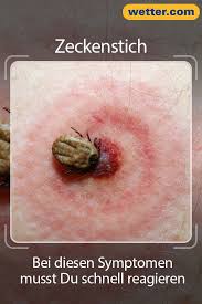 Nach Einem Zeckenstich Bei Diesen Symptomen Musst Du Schnell Reagieren Zecke Zeckenbiss Kopfschmerzen