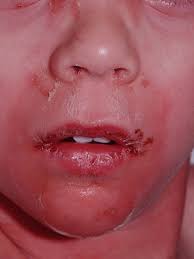 Staphylococcal Scalded Skin Syndrome Amboss