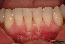 Maybe you would like to learn more about one of these? Do You Have Sensitive Teeth Blue Court Dental Centre Harrow
