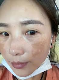 Melasma, known as the “Mask of Pregnancy” does not only occur in pregnant  women, but it can occur in all sorts of skin types, men and women. Learn  more