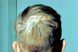 Scalp fungus is also known as tinea capitis. Scalp Infections Causes Symptoms Treatments And Pictures