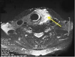An abdominal ultrasound is the traditional method for liver cancer screening, but it misses cancer in its early stages. Papillary Thyroid Cancer Overview Symptoms Treatments And Prognosis For Papillary Thyroid Carcinoma