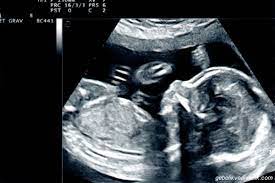 Bebek bekliyorsunuz ve en çok merak ettiğiniz şey bebeğin cinsiyeti. Hamilelikte Bebegin Asagida Olmasi