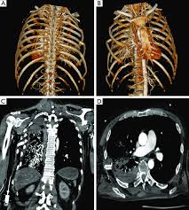 Image result for Flail Chest