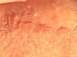 Itchy testicles are both annoying and embarrassing. Ingrown Hair How To Remove Ingrown Hair On Testicles
