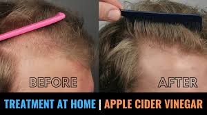 While modern science has lent some support to these and other claims. Hair Loss Treatment At Home With Apple Cider Vinegar Dandruff Itchy Scalp Dry Hair Cure Youtube
