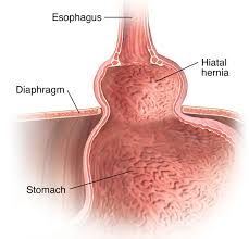 Image result for stomach hernia symptoms