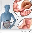 Inclusion intestinale