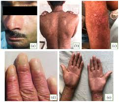 Battling a rarity: A case of kindler syndrome from a developing country