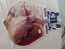 Seeing blood in your urine can be alarming. Hematuria Wikipedia