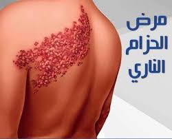 Herpes zoster / shingles)، هو التهاب فيروسيّ حاد في العصب وسطح الجلد المُحيط به الذي يُغذّيه هذا العصب، إذ يظهر على. Ø§Ù„Ø­Ø²Ø§Ù… Ø§Ù„Ù†Ø§Ø±ÙŠ Ø£Ùˆ Ø§Ù„Ø²ÙˆÙ†Ø§ Ø§Ù„Ø­Ø²Ø§Ù… Ø§Ù„Ù†Ø§Ø±ÙŠ Ø£Ùˆ Ù…Ø±Ø¶ Ø§Ù„Ø²ÙˆÙ†Ø§ Ù‡Ùˆ Ø¹Ø¨Ø§Ø±Ø© Ø¹Ù† Ø§Ù„ØªÙ‡Ø§Ø¨ ÙÙŠØ±ÙˆØ³ÙŠ ÙŠØ³Ø¨Ø¨ Ø·ÙØ­ Ø¬Ù„Ø¯ÙŠ ÙˆØªÙ‡ÙŠØ¬ Ù…Ø¤Ù„Ù… ÙÙŠ Ø§Ù„Ù…Ù†Ø·Ù‚Ø© Ø§Ù„Ù…ØµØ§Ø¨Ø© ØªØ­Ø¯Ø« Ø§Ù„Ø¥ØµØ§Ø¨Ø© ÙÙŠ Ø£ÙŠ Ù…Ù†Ø·Ù‚Ø© Ù…Ù† Ø§Ù„Ø¬Ø³Ù… ÙˆØ¹Ø§Ø¯Ø© ÙŠØ¸Ù‡Ø± Ø¹Ù„Ù‰