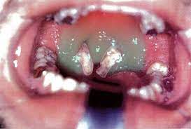 About half of those who have mononucleosis have enlargement of the spleen sometime during the course of their illness. Infectious Mononucleosis Amboss