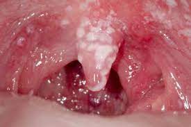 Maybe you would like to learn more about one of these? Oral Thrush Mouth Thrush Nhs