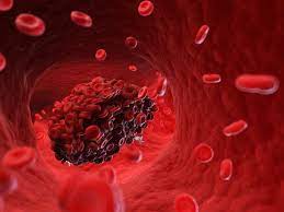 Blood clots can be very serious and need to be treated quickly. Blood Clots Five Reasons They May Happen