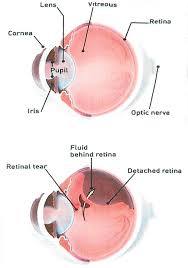A retinal tear can lead to fluid and blood collecting in the eye, which can cause the development of several new floaters and loss of vision if the tear leads to a retinal detachment. Detached And Torn Retina South Florida Health And Wellness Magazine