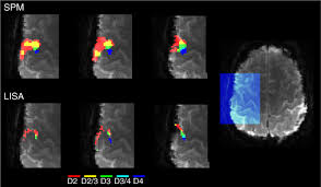 The spm 2017 app lets you view your personal agenda, submit questions, complete surveys, access materials and meeting logistics, take notes, and much more. Lisa Improves Statistical Analysis For Fmri Nature Communications