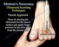 Morton S Neuroma Everything You Need To Know Dr Nabil Ebraheim Morton S Neuroma Neuroma Mortons Neuroma Treatment