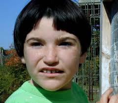 Figure 4 Girl Age Ten Years With Pitt Hopkins Syndrome Note Deep Set Eyes And Depressed Nasal Tip Genereviews Ncbi Bookshelf