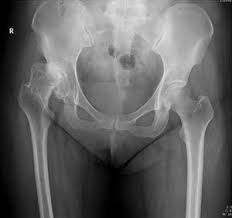 We did not find results for: Hip Dislocation Physiopedia