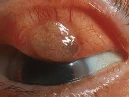 Image result for conjunctival melanoma