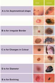 skin cancer is one of the types of cancers that infect humans and is arising from abnormal cells. Profesh