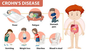 Crohn's disease is a form of inflammatory bowel disease which involves ongoing inflammation of the gastrointestinal tract. Free Vector Medical Infographic Of Crohn S Disease