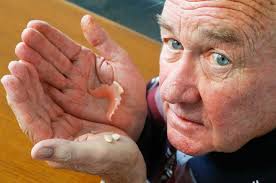 Man's teeth broken during gastroscopy