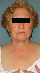 Delayed Adverse Reactions to the Parenteral Administration of Iodinated  Contrast Media