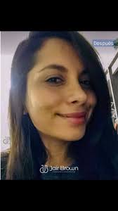 Toda cirugía produce inflamación, a veces de fuera del país nuestros  pacientes nos confirman que van EXCELENTE Y FELICES …Gracias