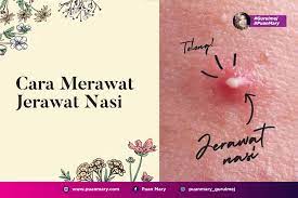 Lidah buaya bekerja cepat dalam menghilangkan jerawat. Cara Menghilangkan Jerawat Nasi Pada Wajah Puan Mary