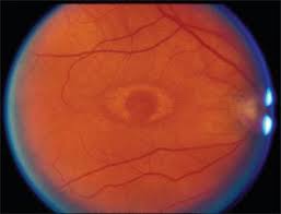 Pin On Eye Doc Stuff